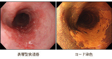 食道癌の診断 | 近畿大学医学部 外科学教室
